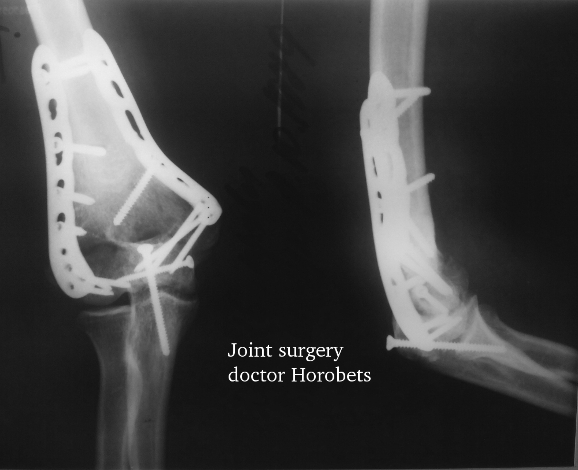 Treatment of intraarticular fractures, osteosynthesis of joint fractures, joint surgery