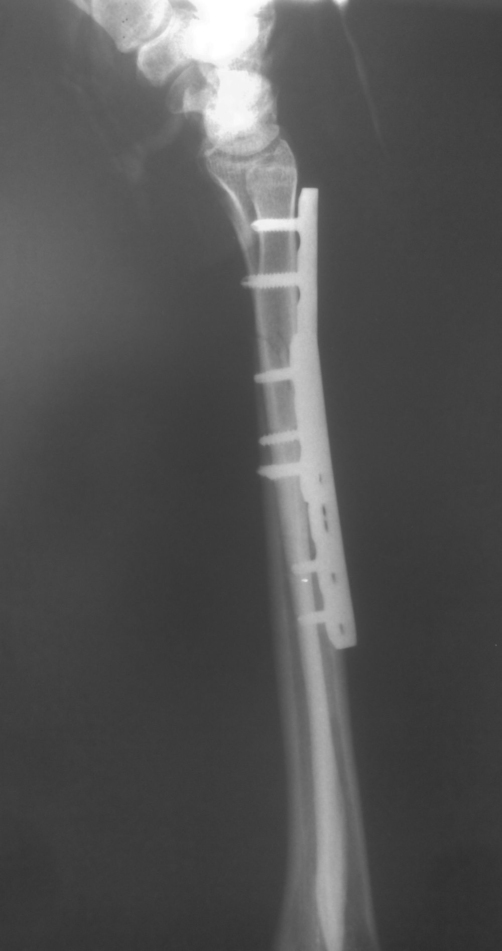 forearm fracture osteosynthesis doctor Gorobets