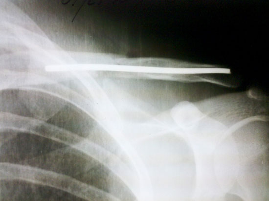 clavicle osteosynthesis with intramedular nail